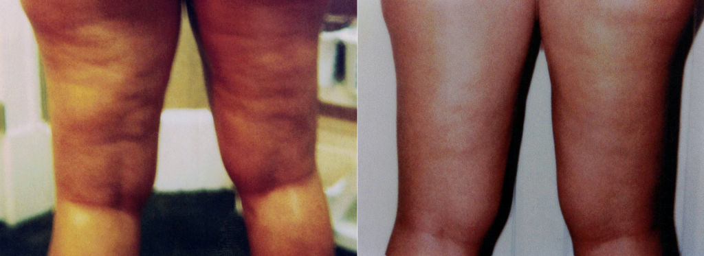 Before and After Leg Wraps