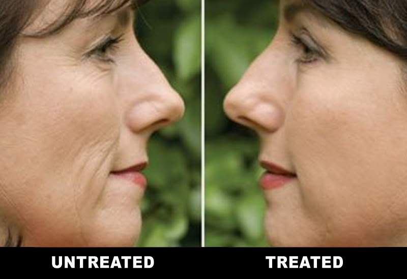 Before and After Microcurrent Facial Toning at American Face & Body Clinic
