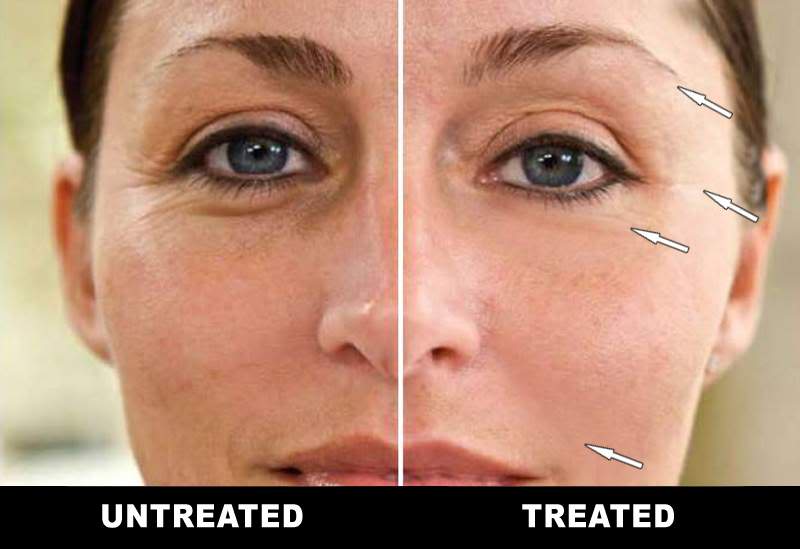 Before and After Microcurrent Facial Toning at American Face & Body Clinic